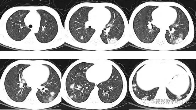 【病例】不典型的肺含铁血黄素沉积症1例CT