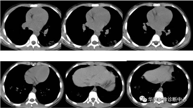 【病例】不典型的肺含铁血黄素沉积症1例CT