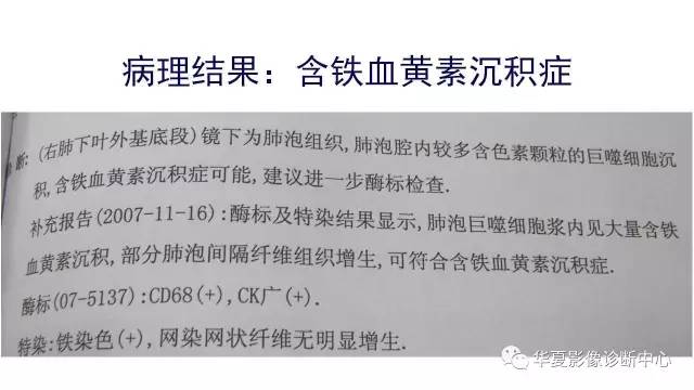 【病例】不典型的肺含铁血黄素沉积症1例CT