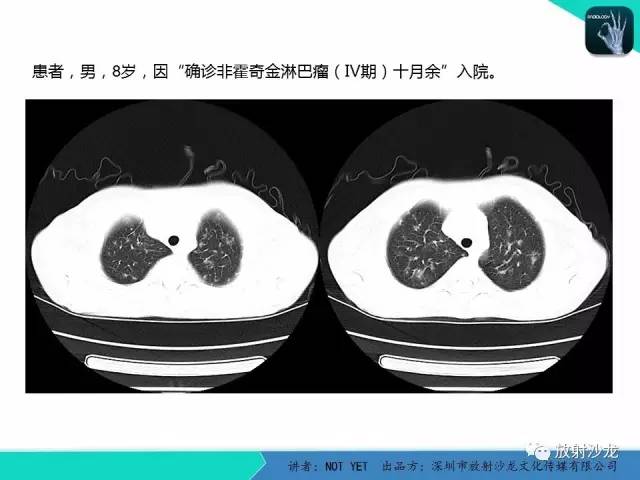 【病例】真菌性肺炎1例CT影像表现