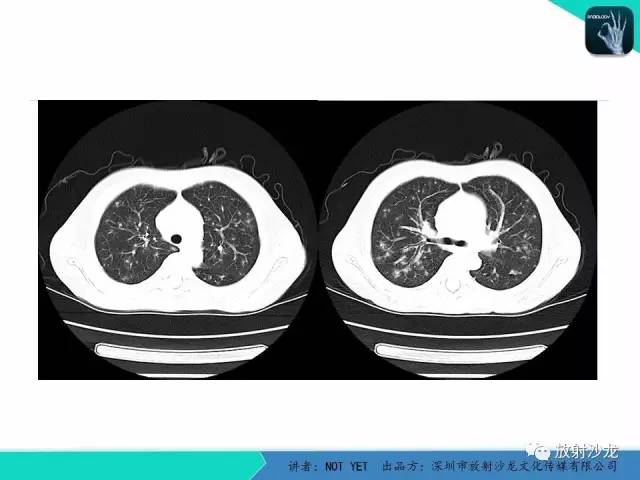 【病例】真菌性肺炎1例CT影像表现