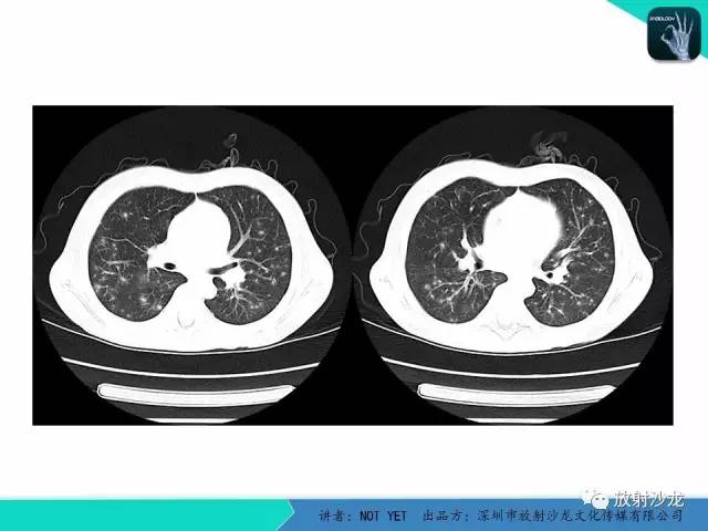 【病例】真菌性肺炎1例CT影像表现