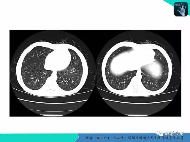 【病例】真菌性肺炎1例CT影像表现