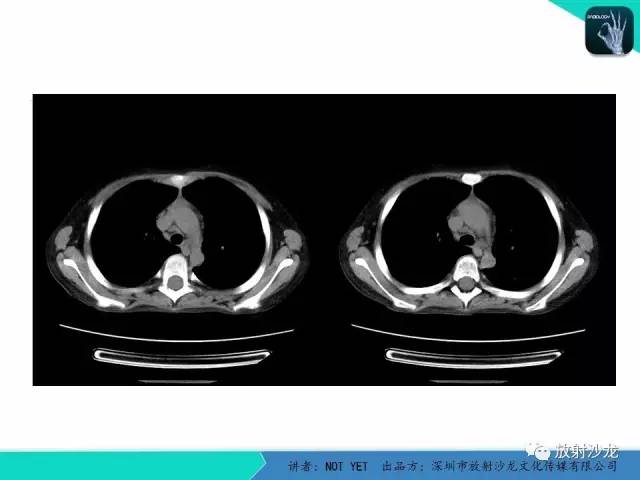 【病例】真菌性肺炎1例CT影像表现