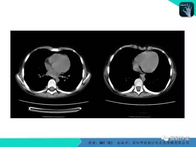 【病例】真菌性肺炎1例CT影像表现