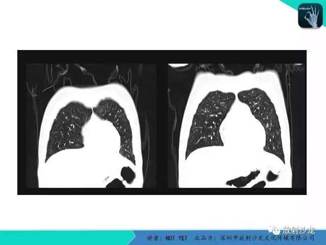 【病例】真菌性肺炎1例CT影像表现