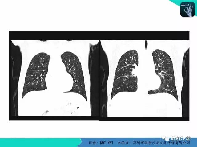 【病例】真菌性肺炎1例CT影像表现