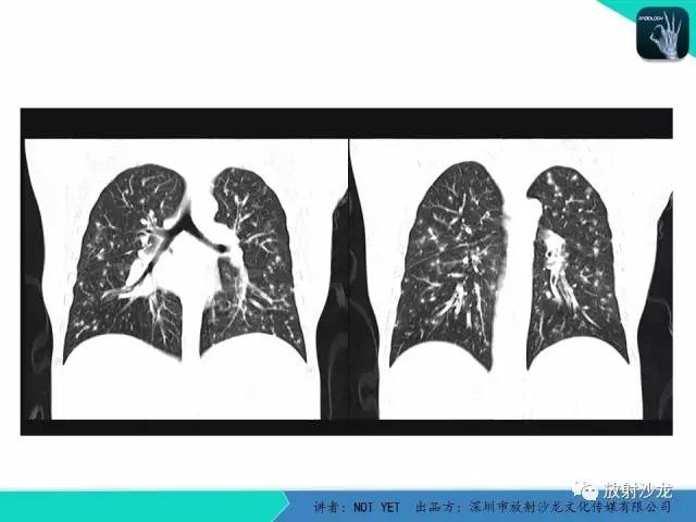 【病例】真菌性肺炎1例CT影像表现