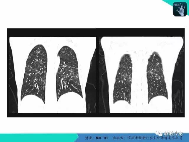 【病例】真菌性肺炎1例CT影像表现