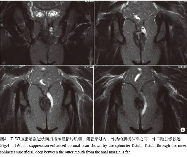 直肠肛门常见的4种疾病 直肠肛门常见的4种疾病