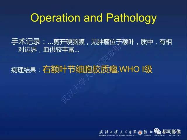 【PPT】节细胞胶质瘤影像诊断