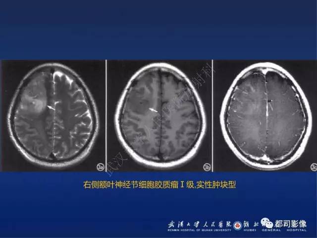 【PPT】节细胞胶质瘤影像诊断