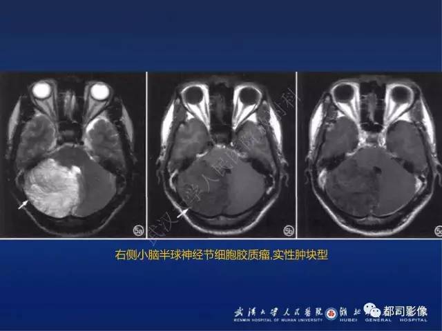 【PPT】节细胞胶质瘤影像诊断