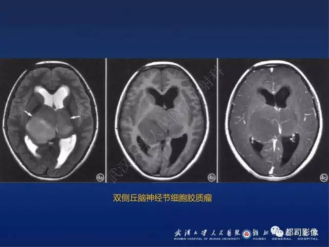 【PPT】节细胞胶质瘤影像诊断
