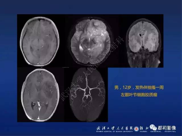 【PPT】节细胞胶质瘤影像诊断