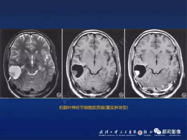 【PPT】节细胞胶质瘤影像诊断