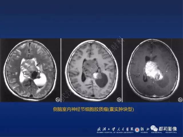 【PPT】节细胞胶质瘤影像诊断