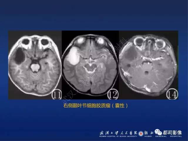 【PPT】节细胞胶质瘤影像诊断
