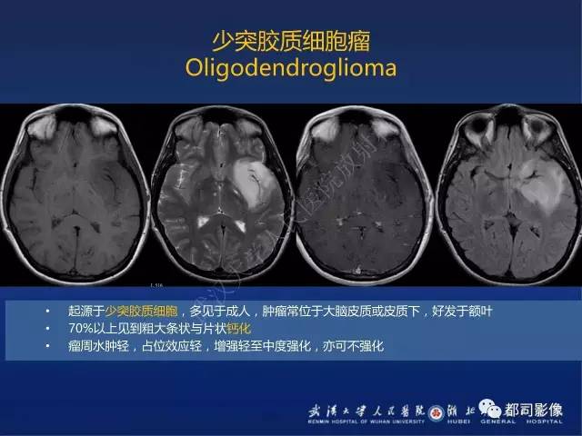 【PPT】节细胞胶质瘤影像诊断