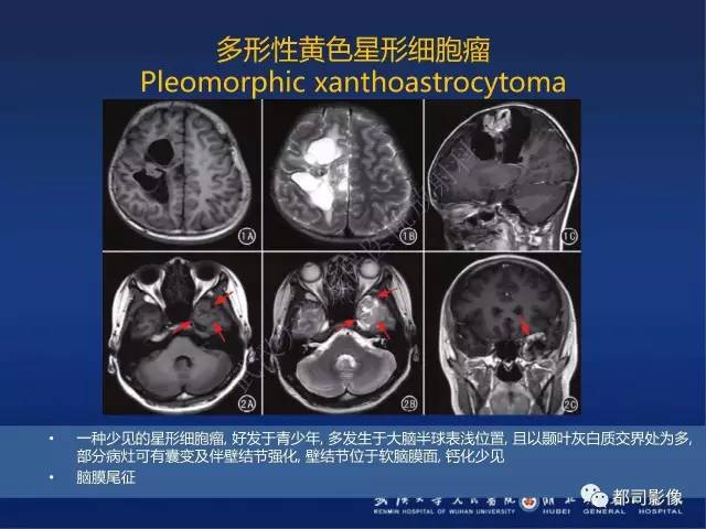 【PPT】节细胞胶质瘤影像诊断
