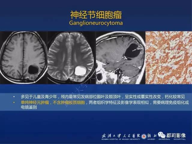 【PPT】节细胞胶质瘤影像诊断
