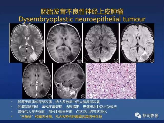 【PPT】节细胞胶质瘤影像诊断