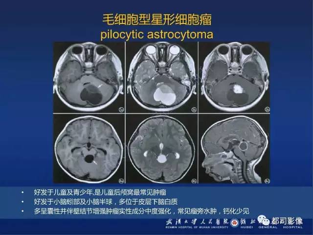 【PPT】节细胞胶质瘤影像诊断