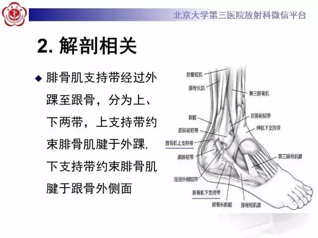 【病例】腓骨肌腱脱位1例MR