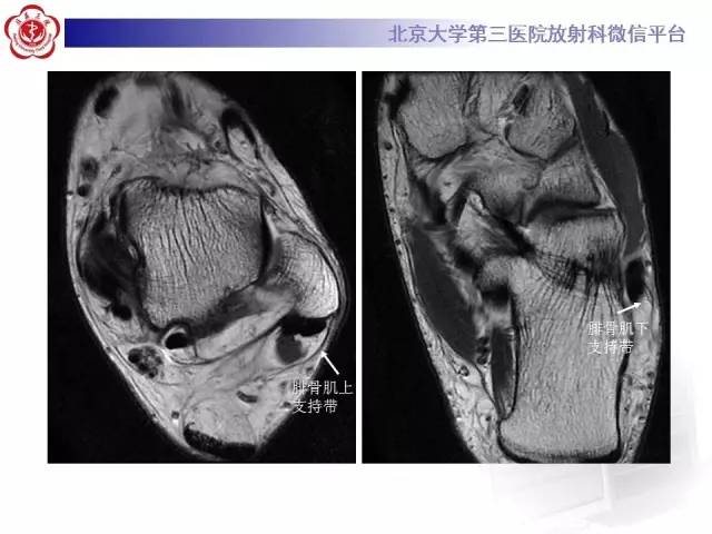 【病例】腓骨肌腱脱位1例MR