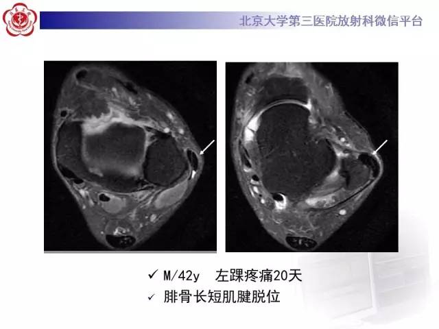 【病例】腓骨肌腱脱位1例MR