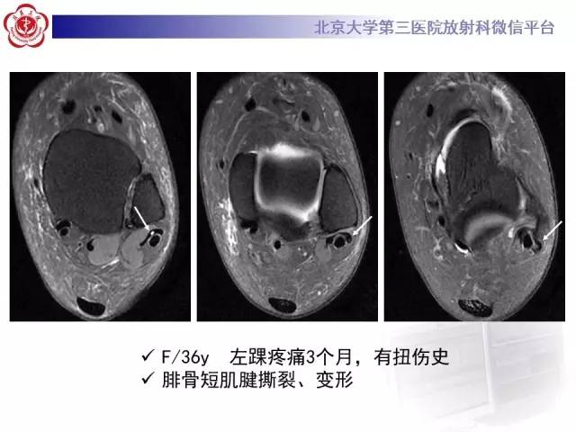 【病例】腓骨肌腱脱位1例MR