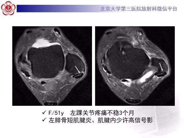 【病例】腓骨肌腱脱位1例MR