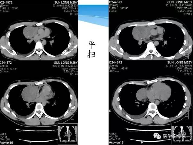 【病例】侵袭性胸腺瘤1例CT影像表现