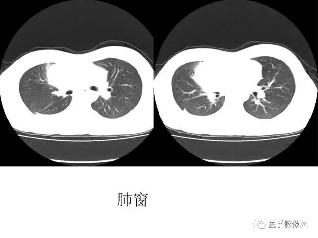 【病例】侵袭性胸腺瘤1例CT影像表现 【病例】侵袭性胸腺瘤1例CT影像表现