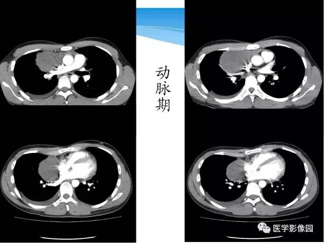 【病例】侵袭性胸腺瘤1例CT影像表现 【病例】侵袭性胸腺瘤1例CT影像表现
