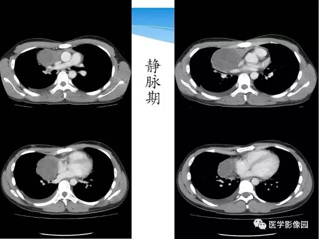 【病例】侵袭性胸腺瘤1例CT影像表现 【病例】侵袭性胸腺瘤1例CT影像表现