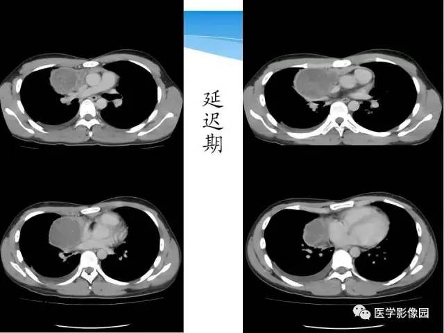 【病例】侵袭性胸腺瘤1例CT影像表现 【病例】侵袭性胸腺瘤1例CT影像表现