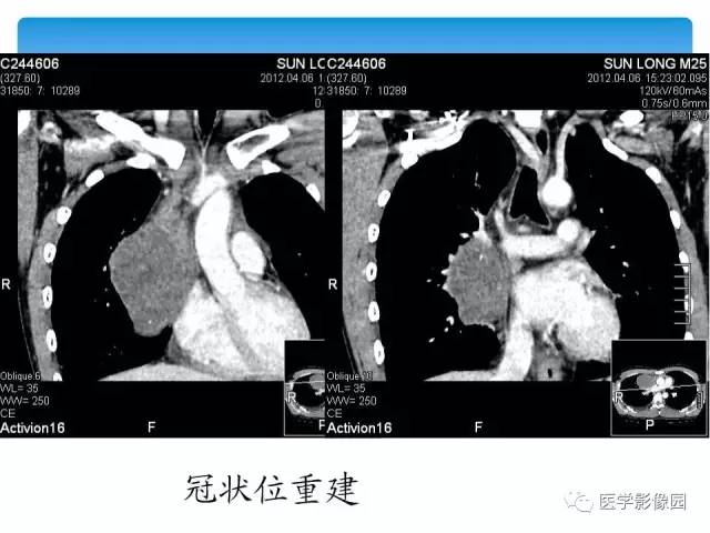 【病例】侵袭性胸腺瘤1例CT影像表现 【病例】侵袭性胸腺瘤1例CT影像表现