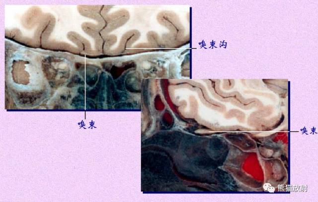 脑神经MRI断层解剖 脑神经MRI断层解剖