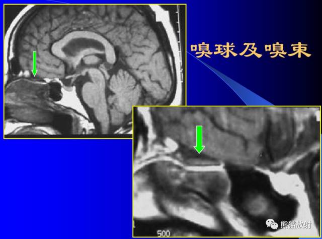脑神经MRI断层解剖 脑神经MRI断层解剖