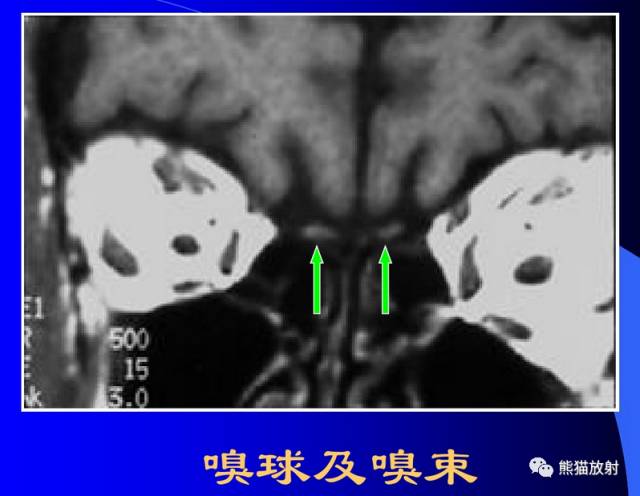 脑神经MRI断层解剖