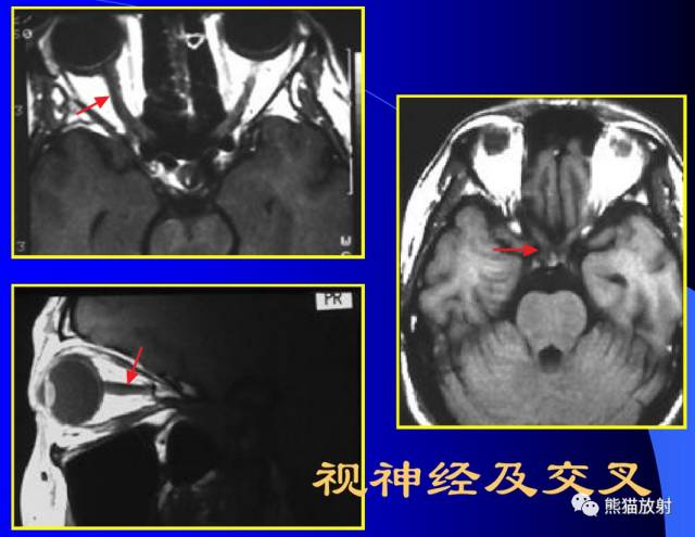 脑神经MRI断层解剖 脑神经MRI断层解剖
