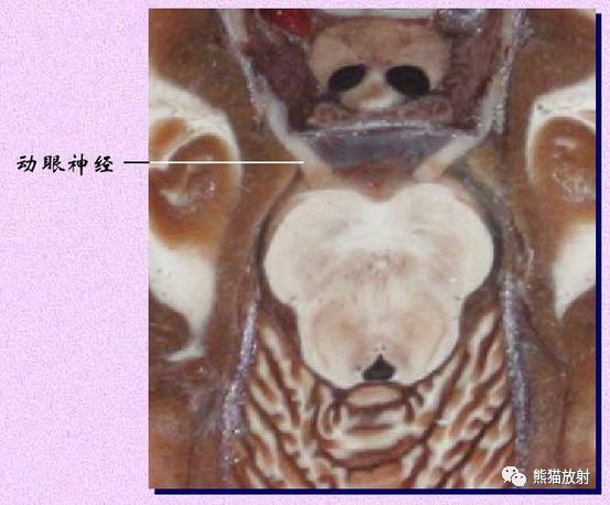 脑神经MRI断层解剖 脑神经MRI断层解剖