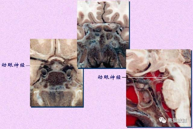 脑神经MRI断层解剖 脑神经MRI断层解剖