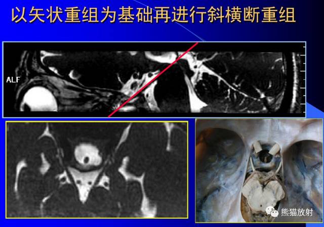 脑神经MRI断层解剖 脑神经MRI断层解剖