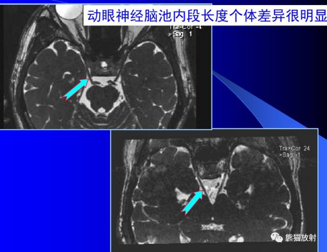 脑神经MRI断层解剖 脑神经MRI断层解剖