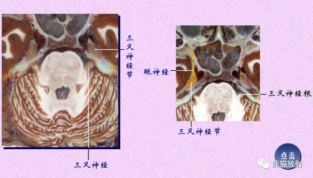 脑神经MRI断层解剖 脑神经MRI断层解剖
