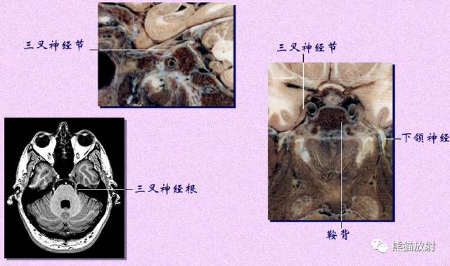 脑神经MRI断层解剖 脑神经MRI断层解剖