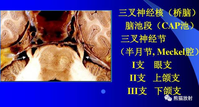 脑神经MRI断层解剖 脑神经MRI断层解剖