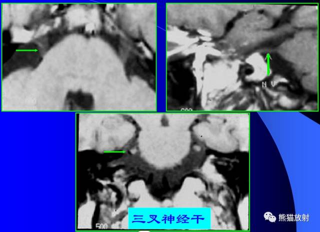 脑神经MRI断层解剖 脑神经MRI断层解剖
